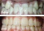 Before and After of the Invisalign number 2