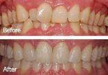 Before and After of the Invisalign treatment, number 3